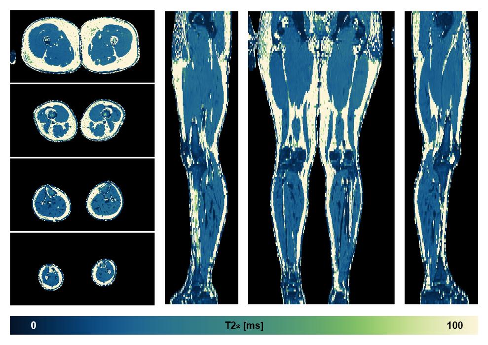 The T2 star relaxation time of the lower extremity obtained from the dixon reconstruction for muscle water fat quantification.